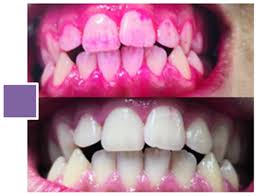 Dental Plaque