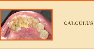 Dental calculus