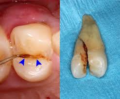 cracked Tooth Syndrome