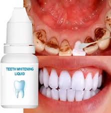 teeth whitening