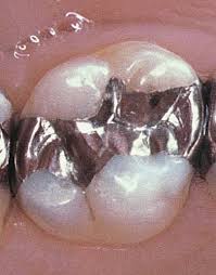 silver amalgam filling