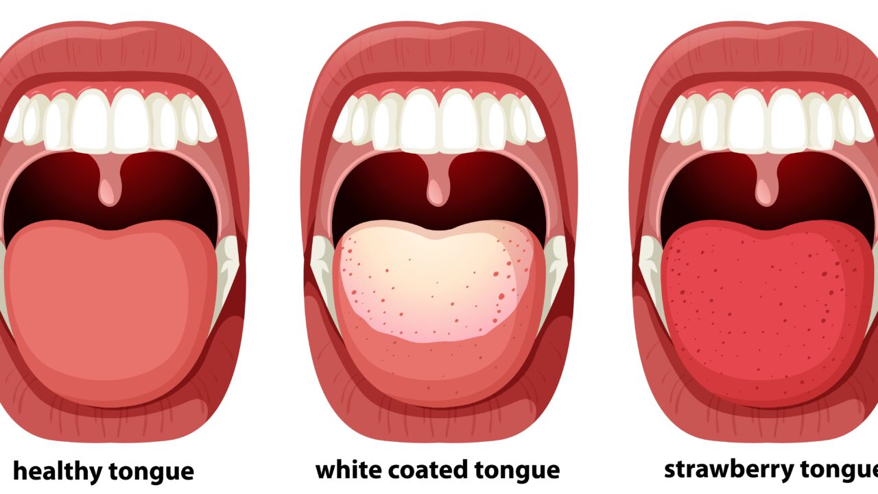 White tongue: causes & prevention