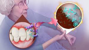Arthritis- Periodontitis connetion