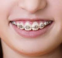 Dental Braces