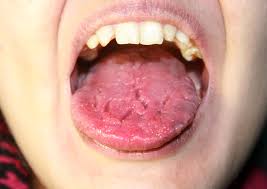 Xerostomia