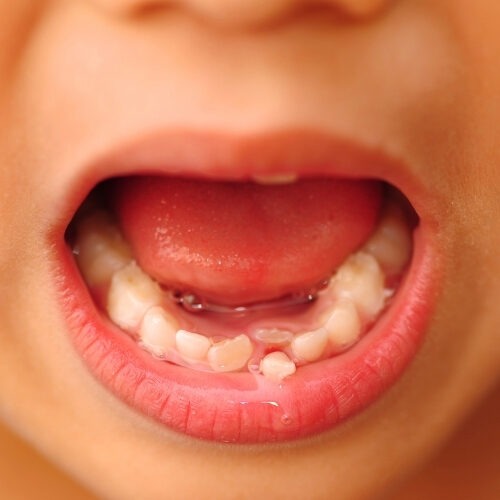 Baby Teeth Shedding