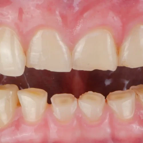 Bruxism in adults