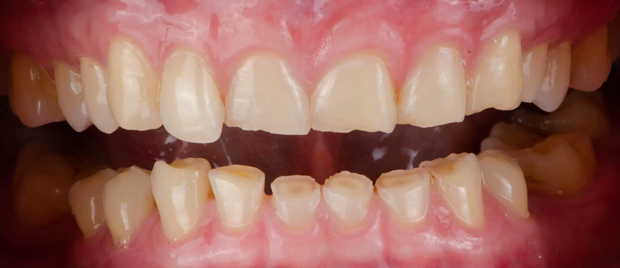 Bruxism in adults