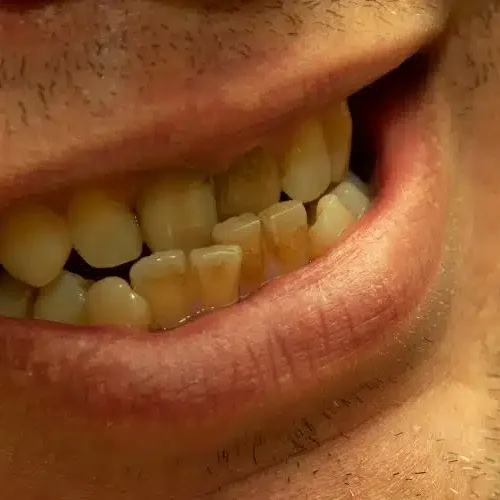 Misaligned Bites
