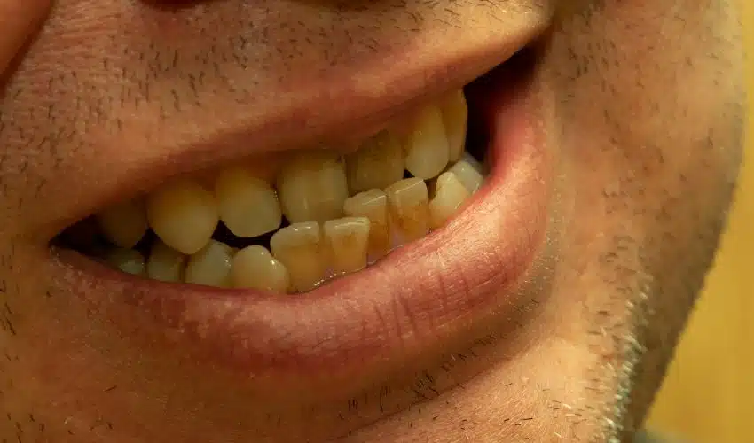 Misaligned Bites