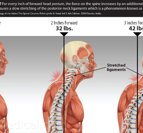 poor head posture