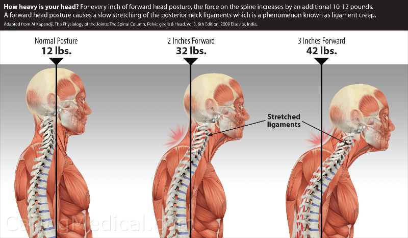 poor head posture