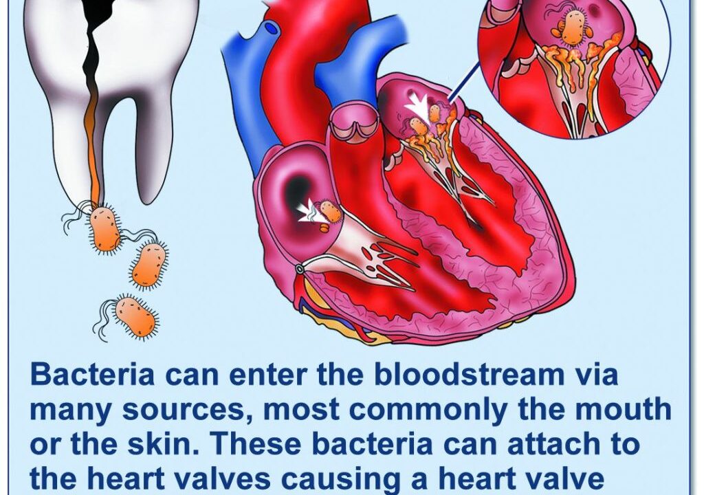 endocarditis