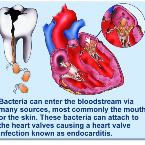 endocarditis
