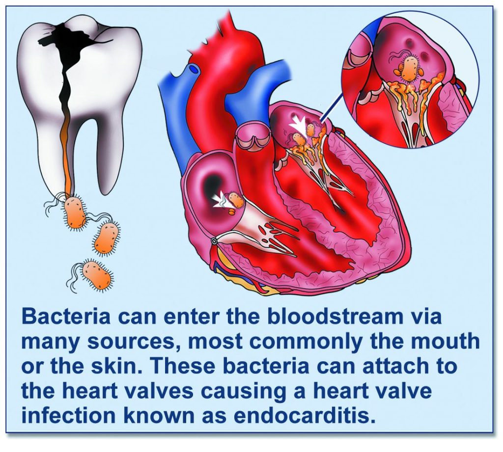 endocarditis