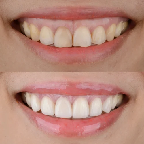 Gummy smile