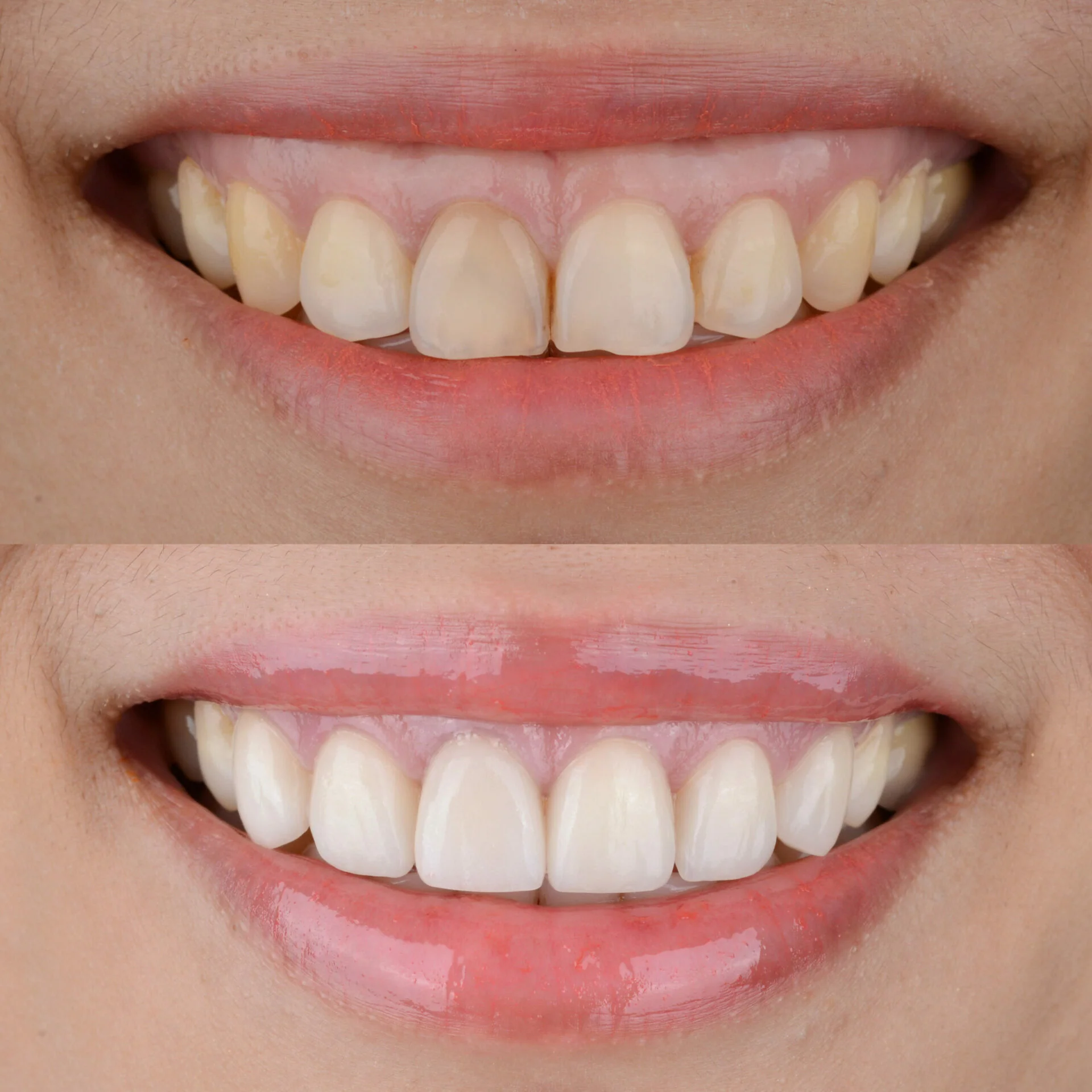 Gummy smile