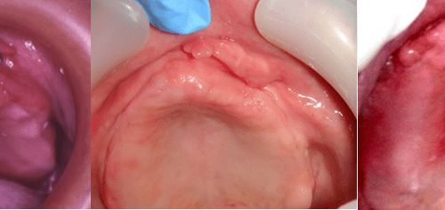 Ill-fitting dentures