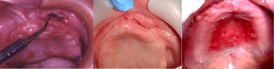 Ill-fitting dentures