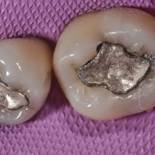 Secondary Tooth decay