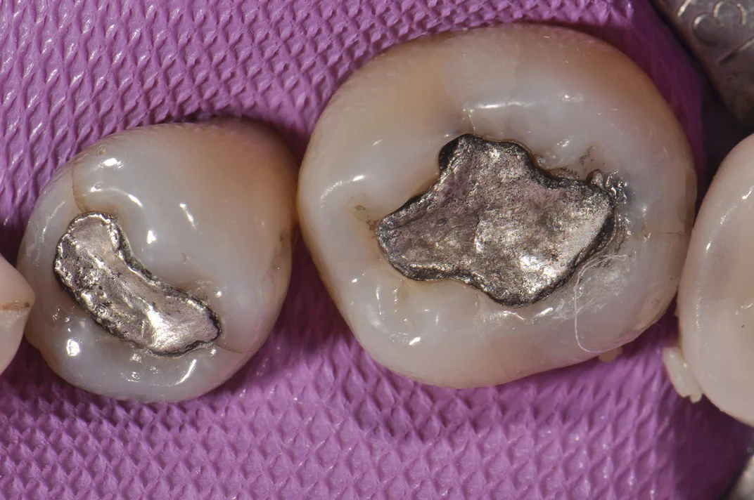 Secondary Tooth decay
