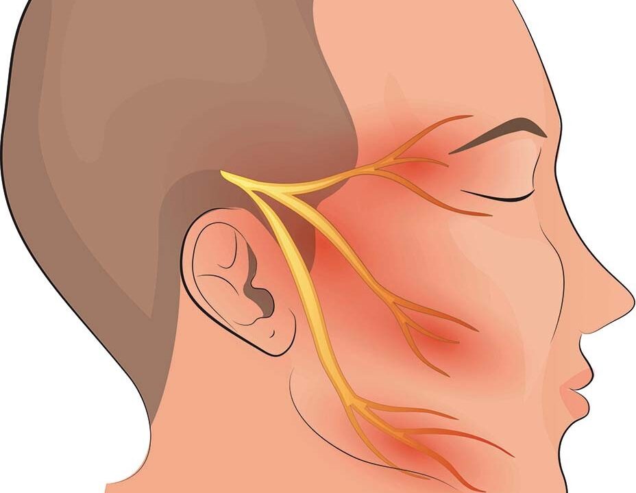 Trigeminal neuralgia