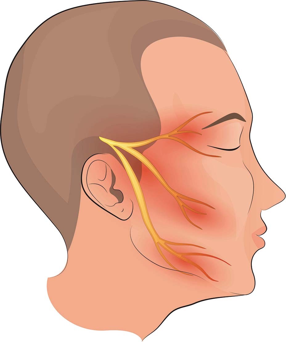 Trigeminal neuralgia