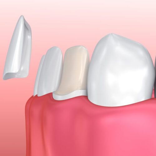 Dental Veneers