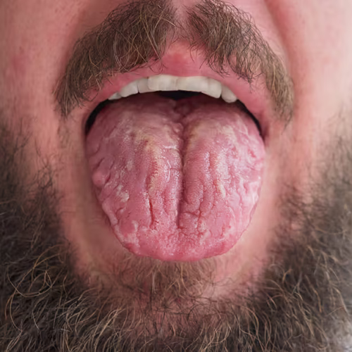 Fissured Tongue