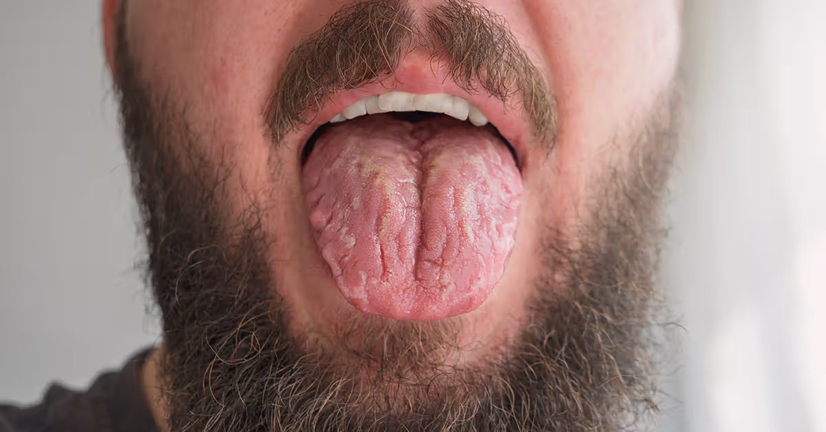 Fissured Tongue