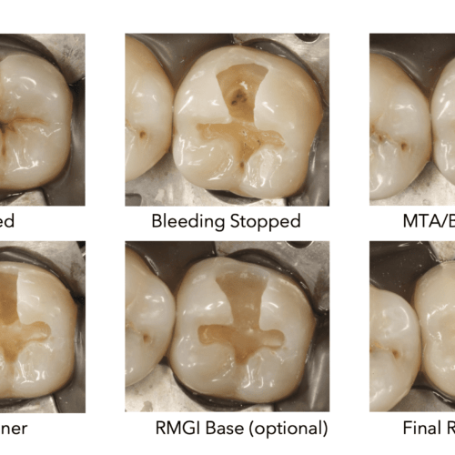 Pulp capping