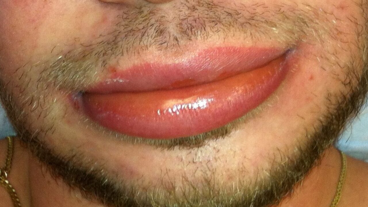 angioedema