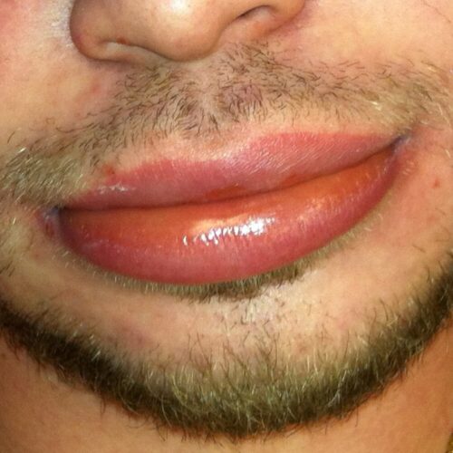 angioedema