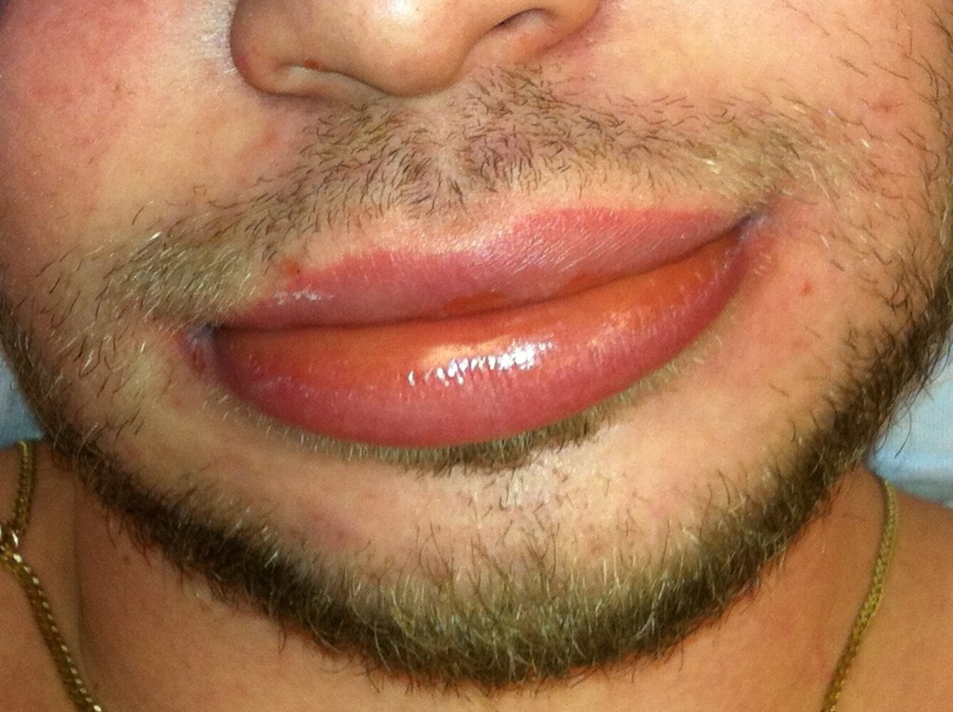 angioedema