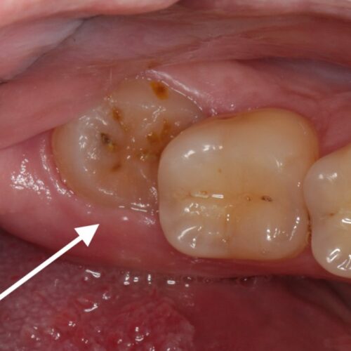 complex wisdom tooth