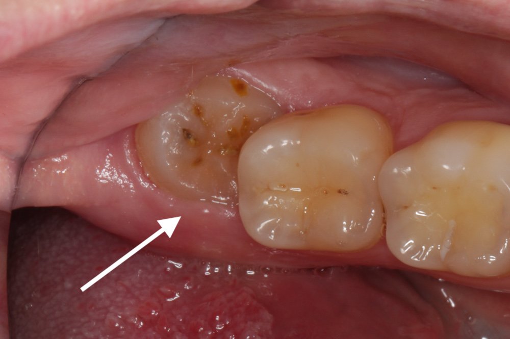 complex wisdom tooth