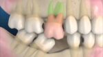 Long term Consequences of a tooth extraction 