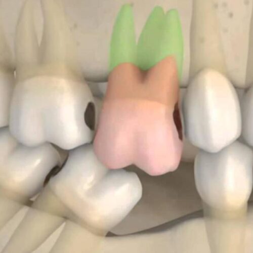 consequences of tooth extraction