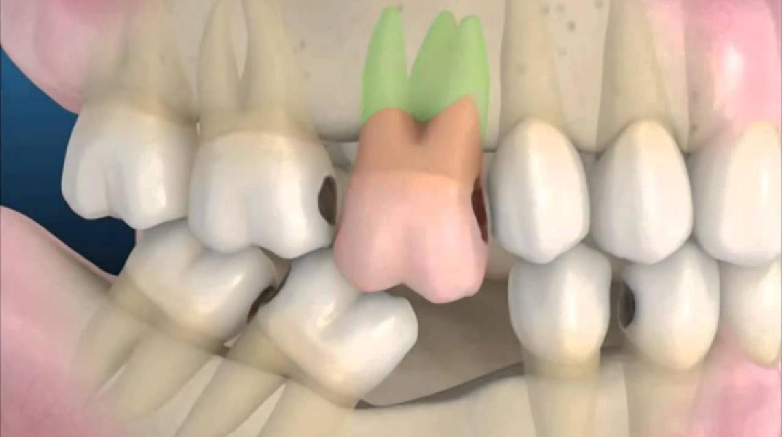 Long term Consequences of a tooth extraction 