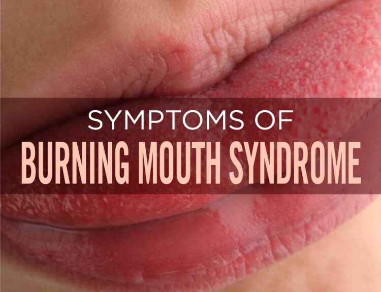 Burning Mouth syndrome