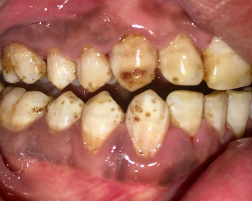 Dental Fluorosis