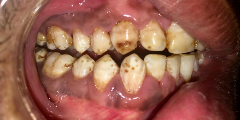Dental Fluorosis