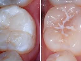 Fissure Sealants