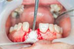 Bone Grafting in Periodontal Bone Loss
