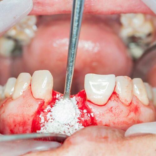 Bone grafting