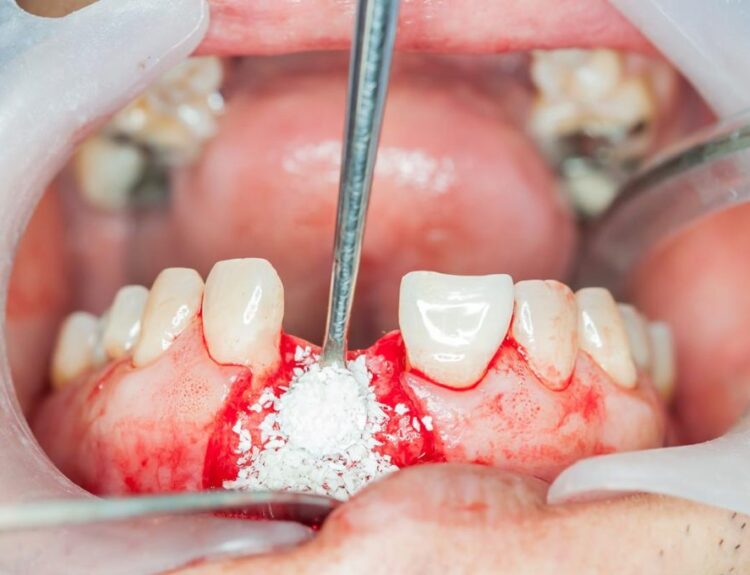 Bone grafting