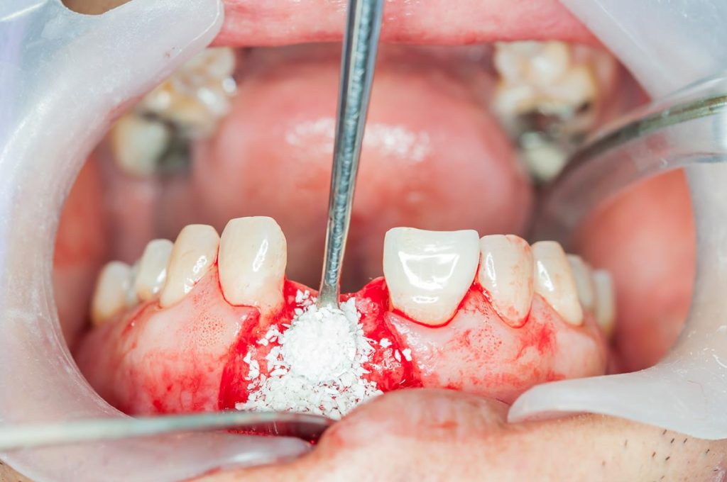 Bone grafting