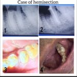 Tooth Hemisection: An Approach to Save Compromised Molars