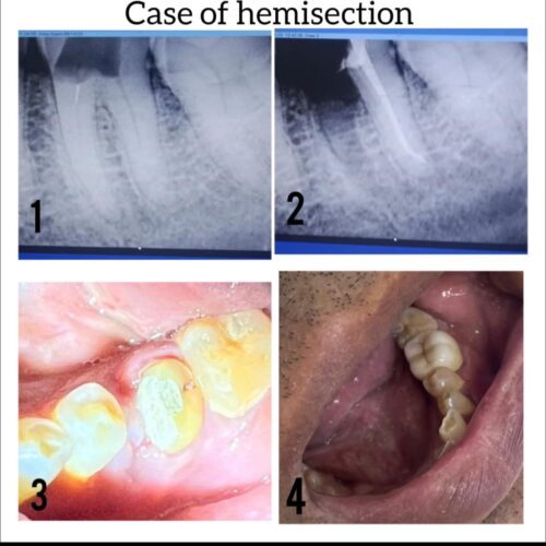 Hemiscetion