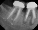 Root Canal Treatment Failure: Common Causes